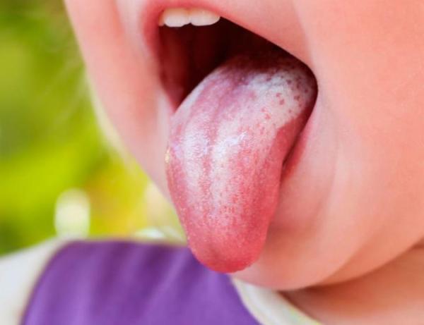 دلیل برفک دهانی چیست؟و راه درمان آن چه می باشد؟