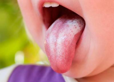 دلیل برفک دهانی چیست؟و راه درمان آن چه می باشد؟